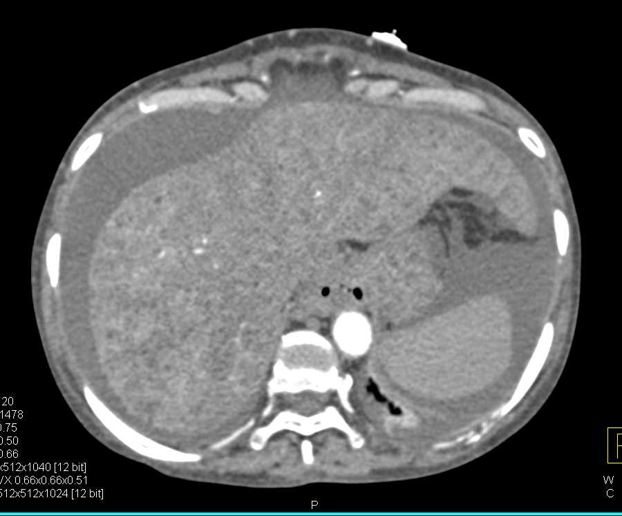 Biliary Cirrhosis Liver - Liver Case Studies - CTisus CT Scanning