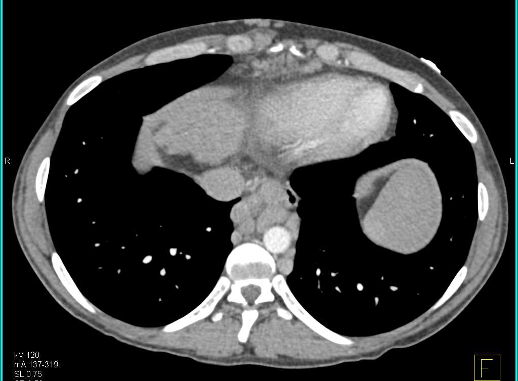 Cirrhosis with Portal Hypertension and Varices and Splenomegaly - CTisus CT Scan