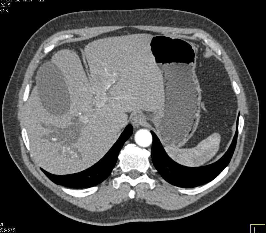 Ampullary Carcinoma with Stent in Common Bile Duct (CBD) - CTisus CT Scan