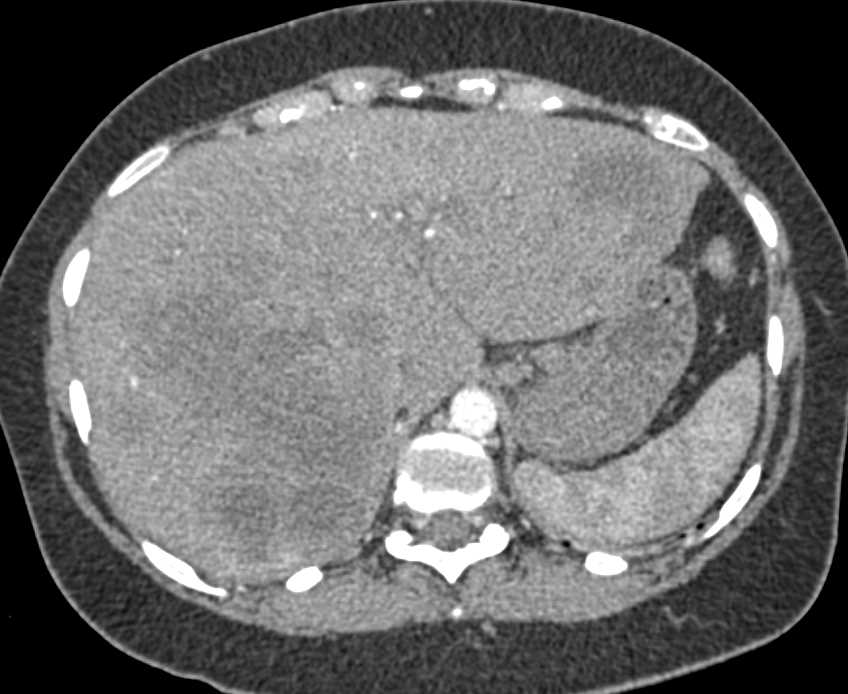 Lymphoma Infiltrates the Pancreas and Peripancreatic Nodes as Well as Hepatic Tumor - CTisus CT Scan