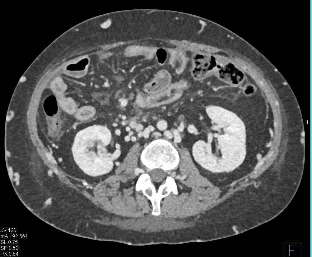 Cirrhosis with Portal Hypertension and Large Varices - CTisus CT Scan