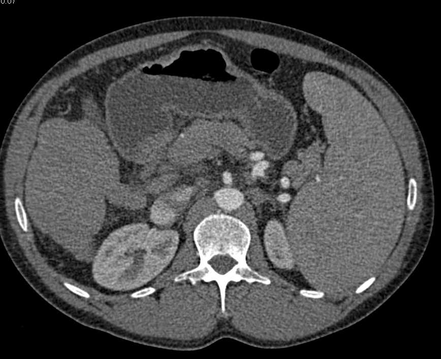 Cirrhosis with Portal Hypertension and Varices and Splenomegaly - CTisus CT Scan