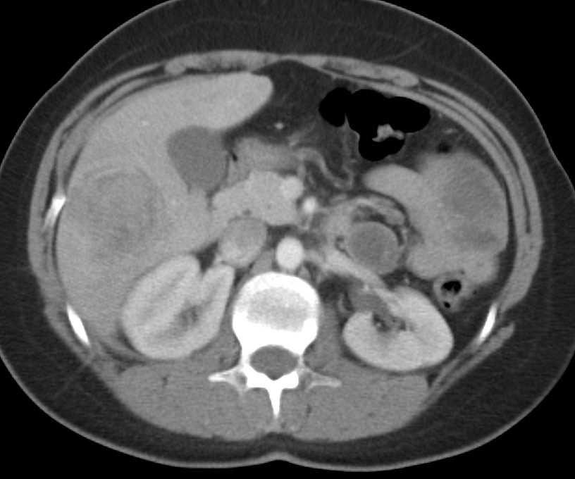 Spontaneous Bleed in a Hepatic Adenoma - CTisus CT Scan