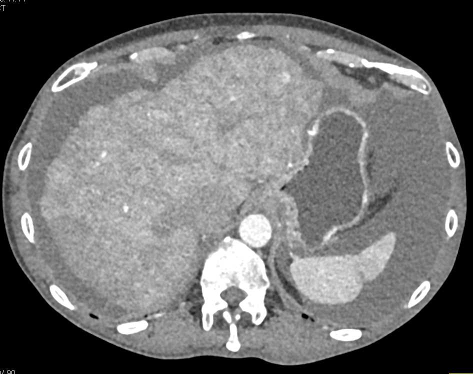 Multifocal Hepatocellular Carcinoma (Hepatoma) in a Cirrhotic Liver - CTisus CT Scan