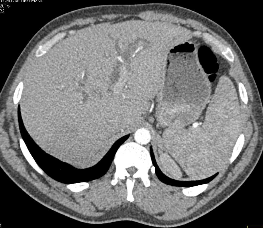 Cholangiocarcinoma - CTisus CT Scan