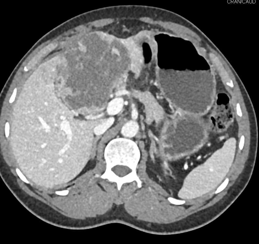 Hepatocellular Carcinoma (Hepatoma) with Neovascularity Invades the Inferior Vena Cava (IVC) - CTisus CT Scan