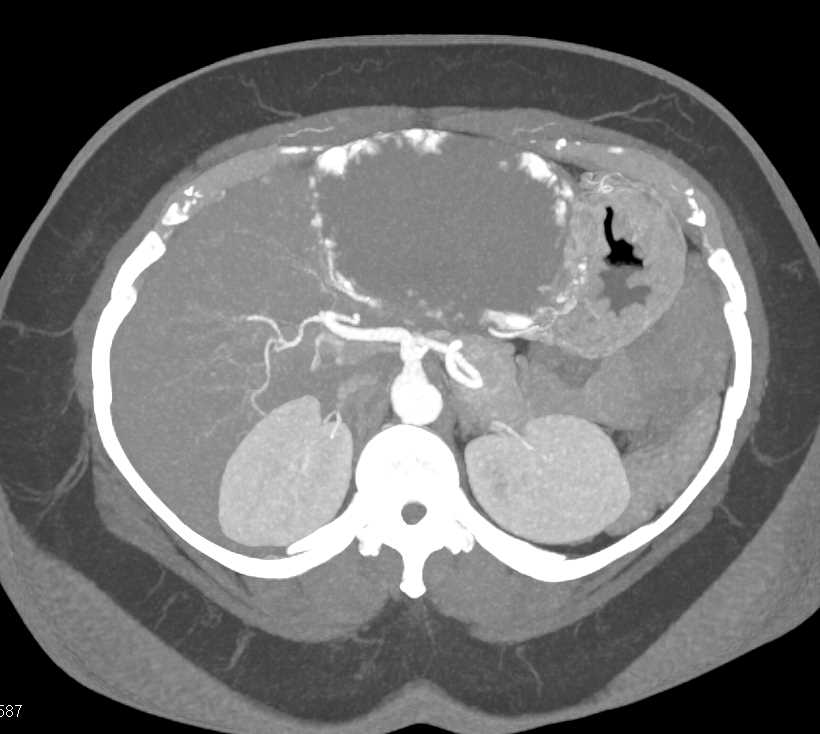 Giant Cavernous Hemangioma - CTisus CT Scan