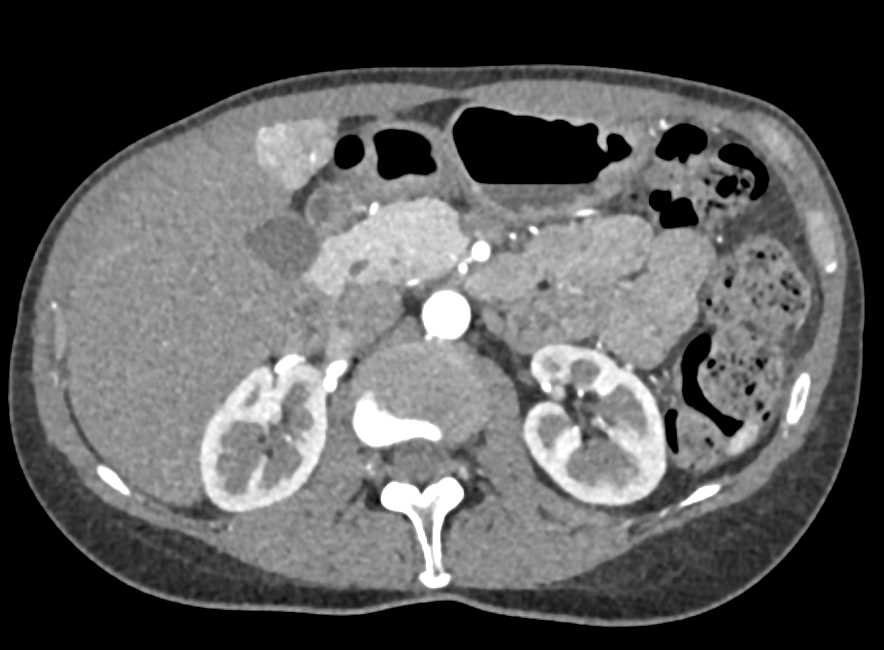 Multiple Focal Nodular Hyperplasia (FNH) Liver - CTisus CT Scan