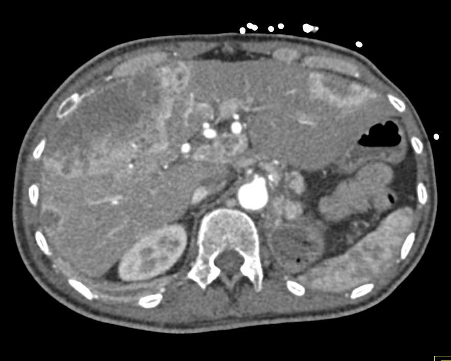 Metastatic Cholangiocarcinoma - CTisus CT Scan
