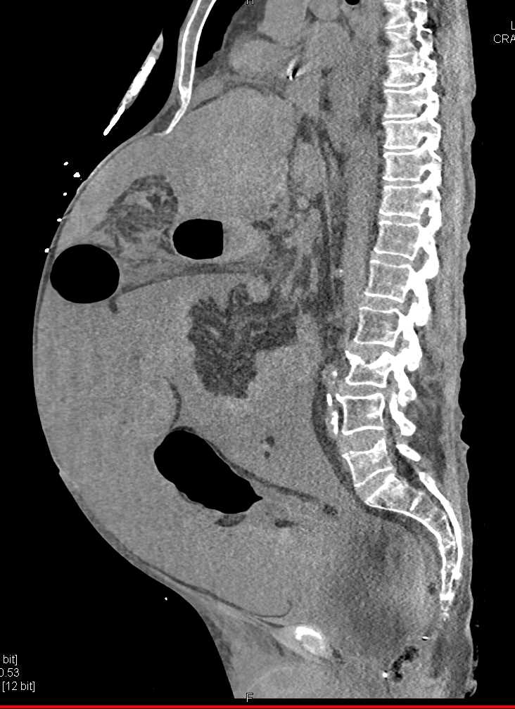 Cirrhosis with Massive Ascites - Liver Case Studies - CTisus CT Scanning