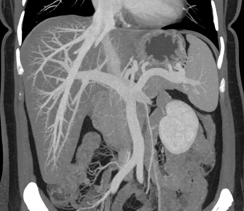 3D of the Hepatic Veins - CTisus CT Scan