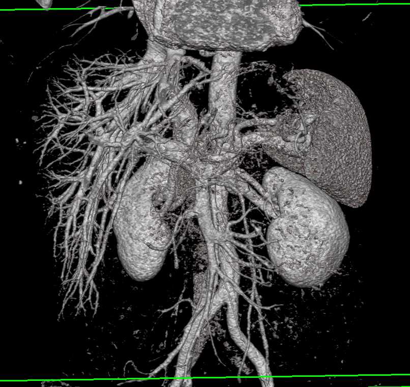 3D of the Hepatic Veins - Liver Case Studies - CTisus CT Scanning