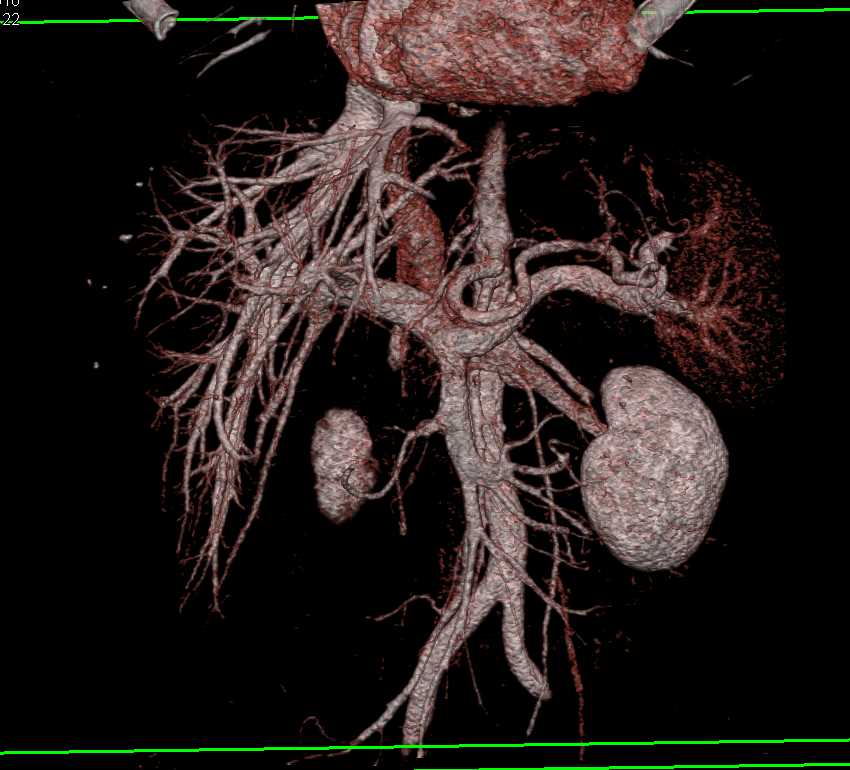 3D of the Hepatic Veins - Liver Case Studies - CTisus CT Scanning