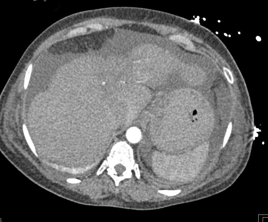 Hepatocellular Carcinoma (Hepatoma) Arises in a Liver with Cirrhosis - CTisus CT Scan