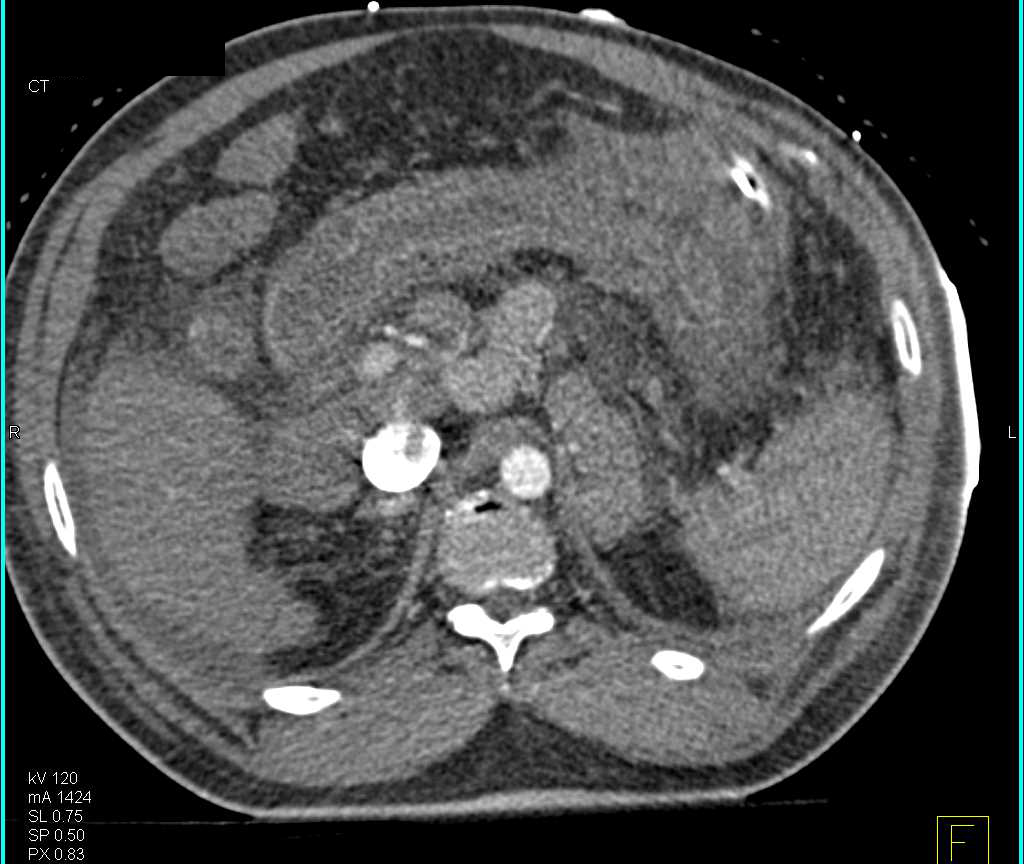 Cirrhosis with Edematous Small Bowel - CTisus CT Scan