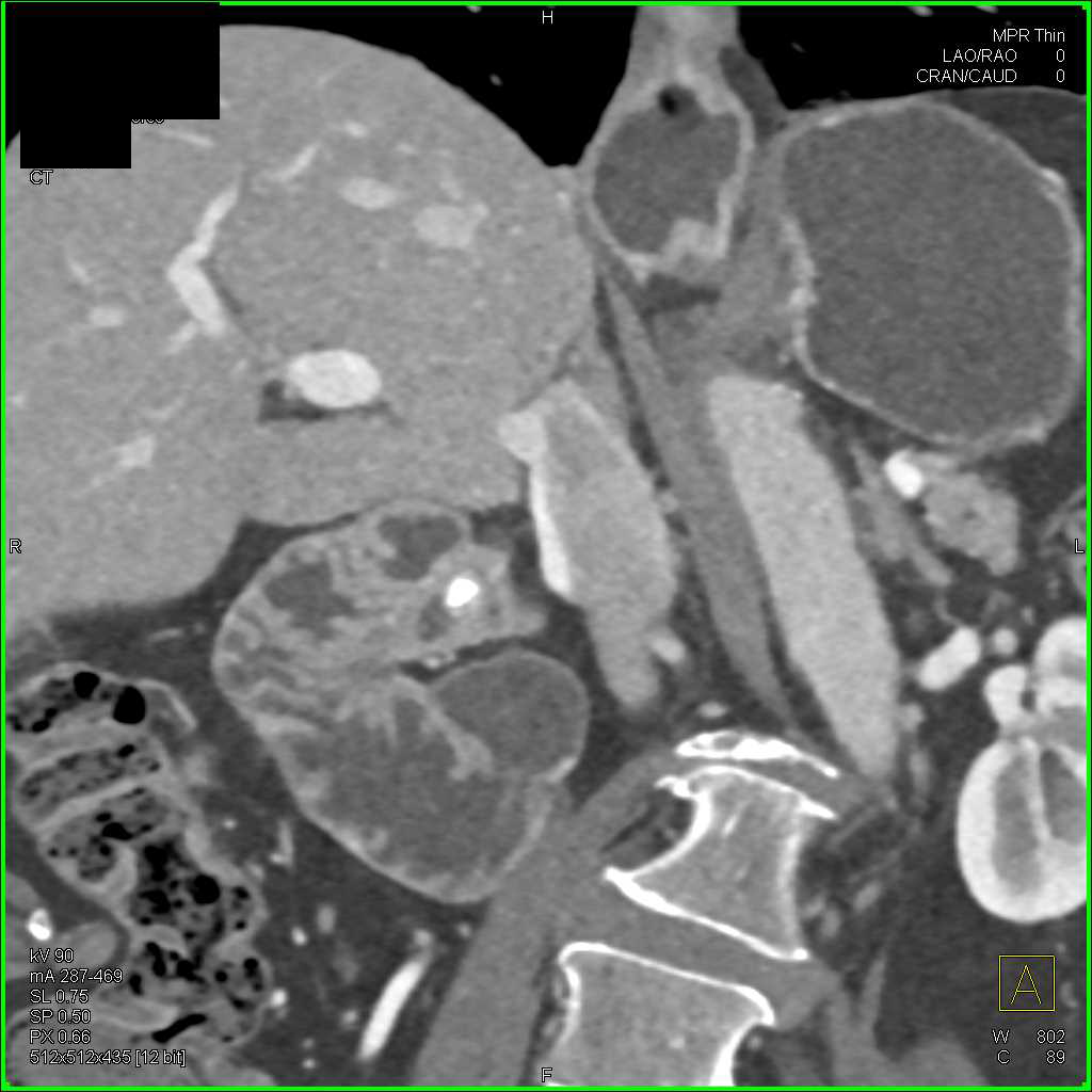 Stone in Distal Common Bile Duct - CTisus CT Scan