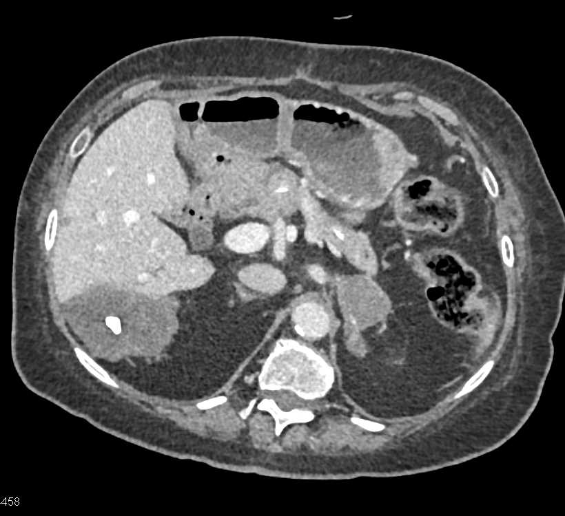 Sclerosed Hemangioma Right Lobe of the Liver - CTisus CT Scan