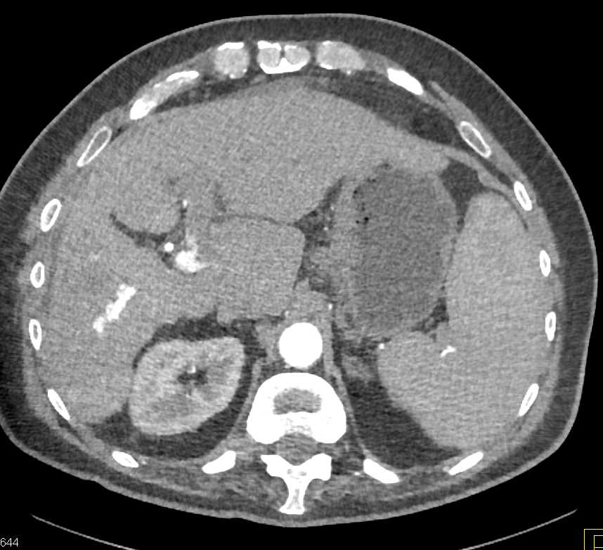 Cirrhosis with Arteriovenous (AV) Shunt in the Left Lobe of the Liver - CTisus CT Scan