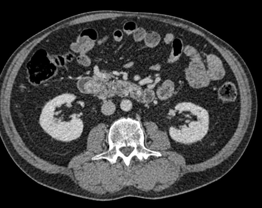 Ampullary Carcinoma which Involves the  Duodenum - CTisus CT Scan