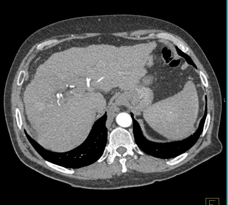 Cirrhosis with Portal Hypertension and Varices and Splenomegaly - CTisus CT Scan