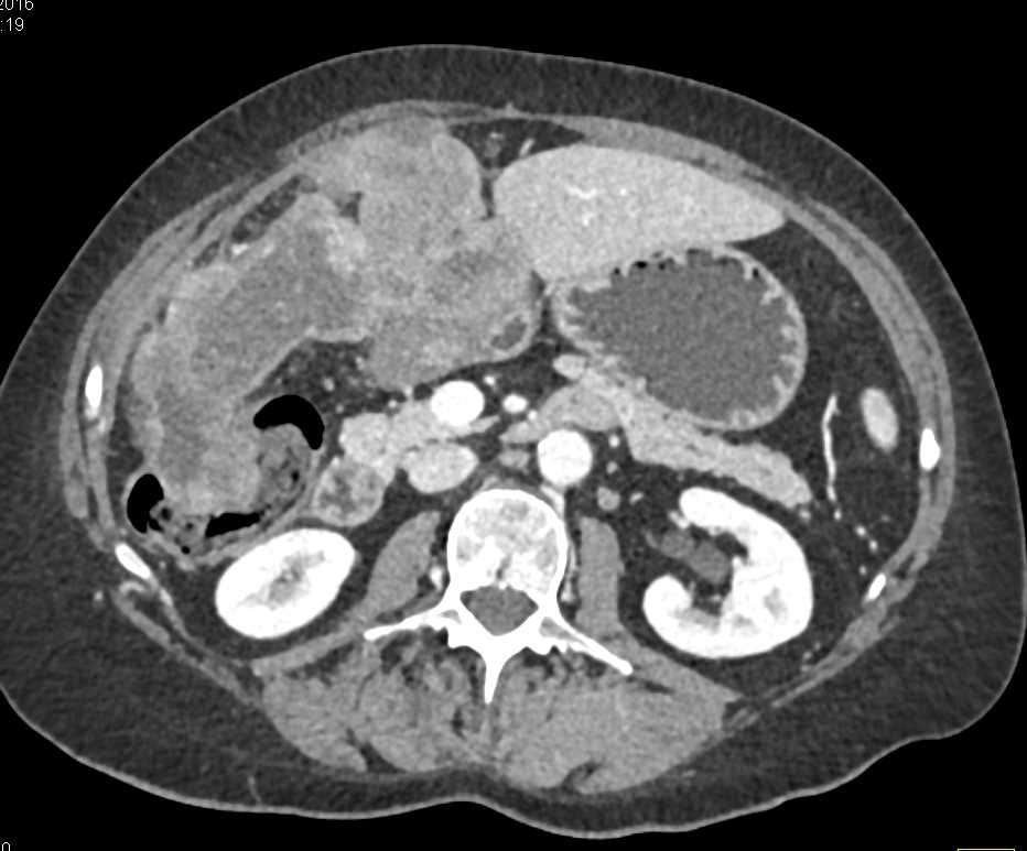 Metastatic Ovarian Cancer to Omentum and Peritoneal Zone - CTisus CT Scan