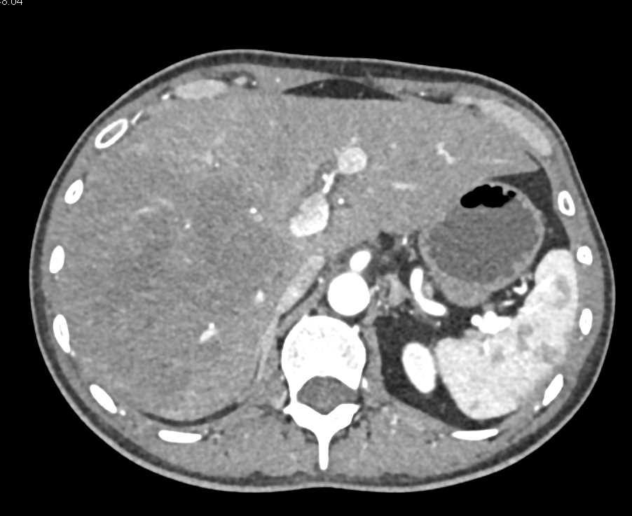 Hepatocellular Carcinoma (Hepatoma) Arises in a Liver with Cirrhosis - CTisus CT Scan