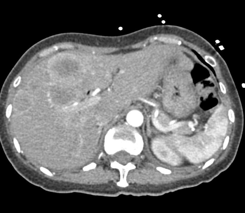 Pancreatic Adenocarcinoma with Liver Metastases - CTisus CT Scan