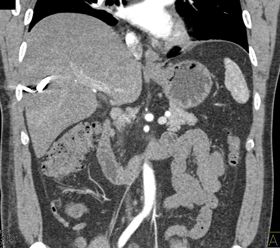 Liver Abscesses Which Simulate Tumor and Metastases - CTisus CT Scan