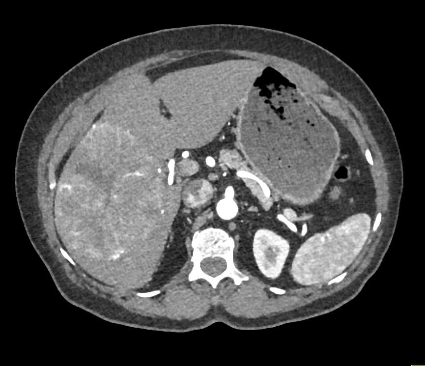 Hepatocellular Carcinoma (Hepatoma) with Pseudocapsule and Neovascularity - CTisus CT Scan