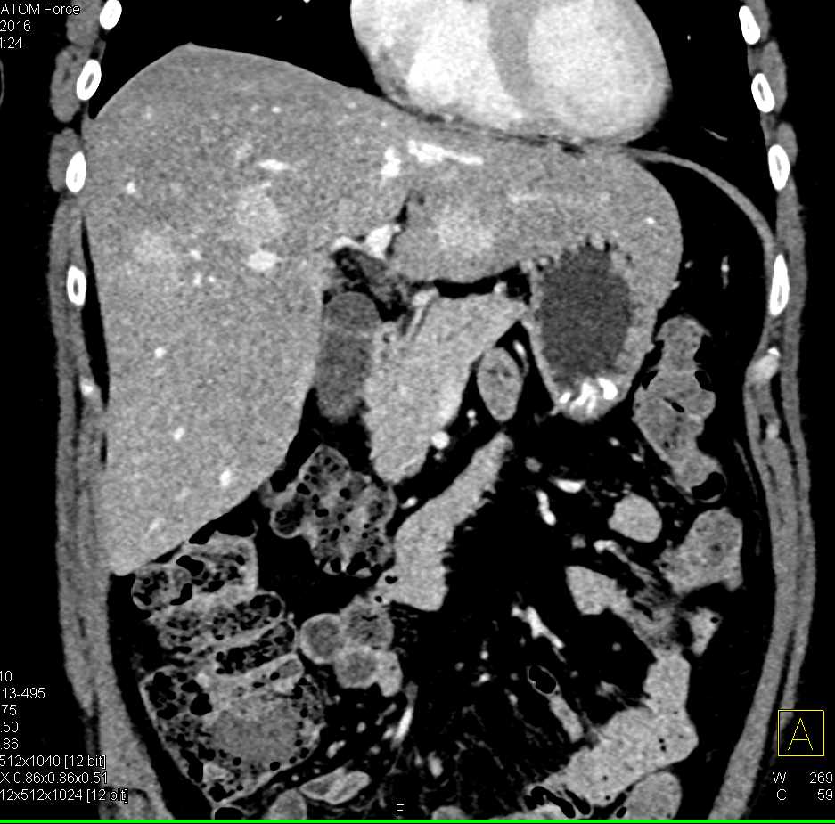 Metastatic Carcinoid Tumor to the Liver - CTisus CT Scan