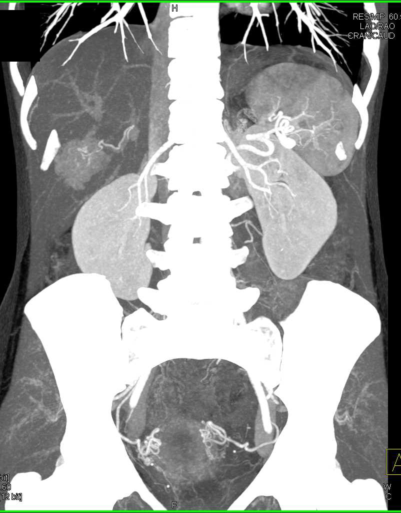 Focal Nodular Hyperplasia Fnh Liver Liver Case Studies Ctisus Ct