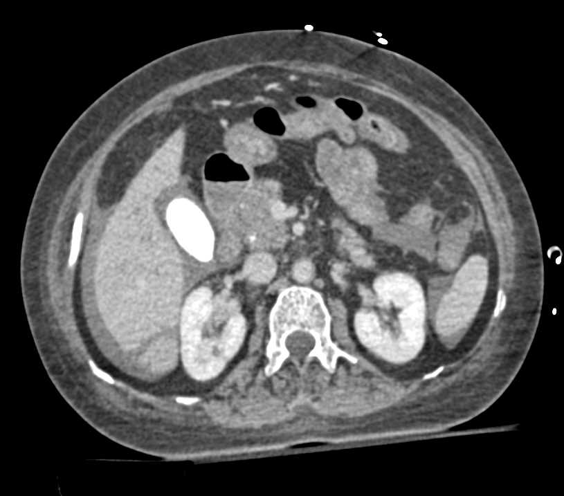 Liver Laceration with Hemoperitoneum - CTisus CT Scan