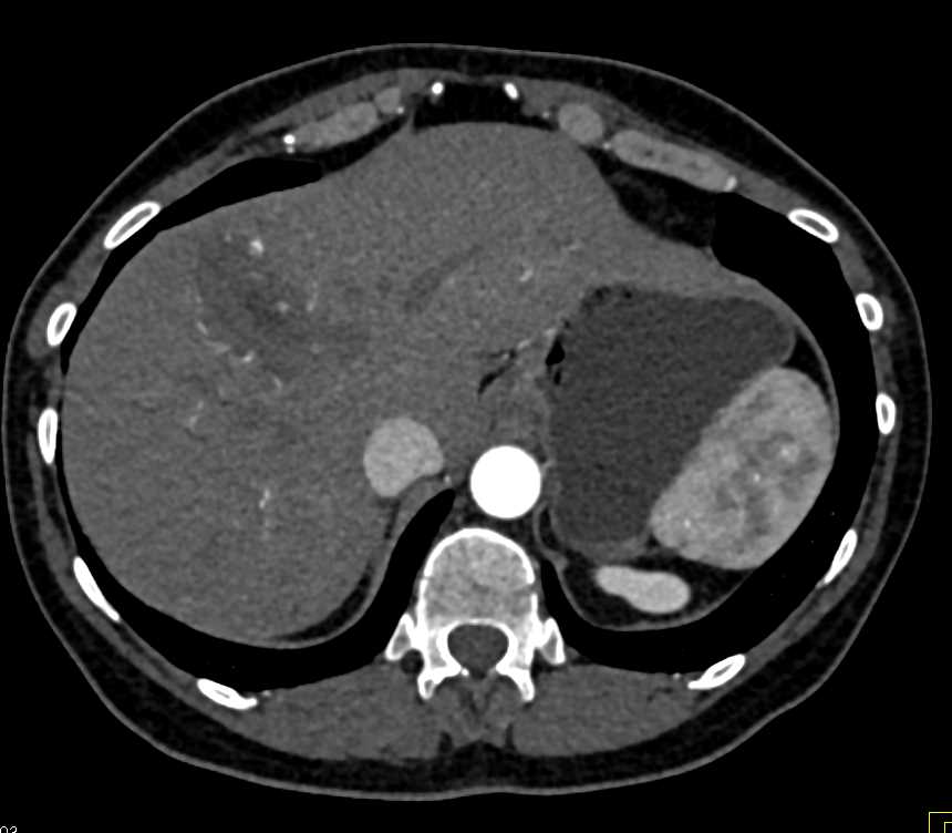 Multiple Hepatic Hemangiomas - CTisus CT Scan