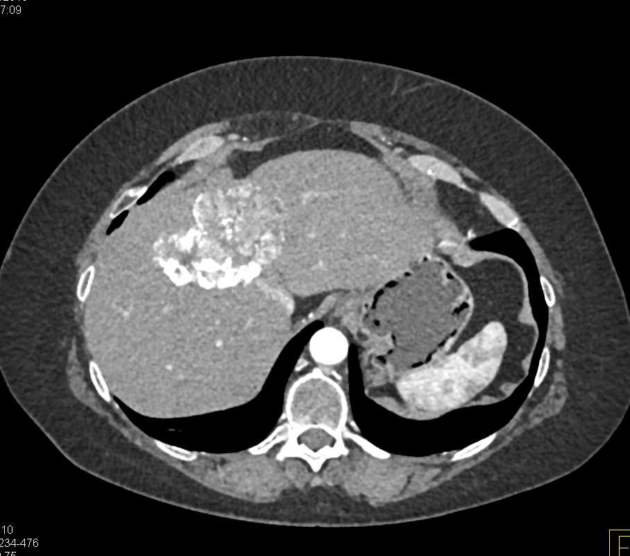 Atypical Vascularity for a Hepatic Hemangioma - CTisus CT Scan