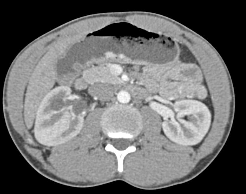 Giant Cavernous Hemangioma of the Liver - CTisus CT Scan