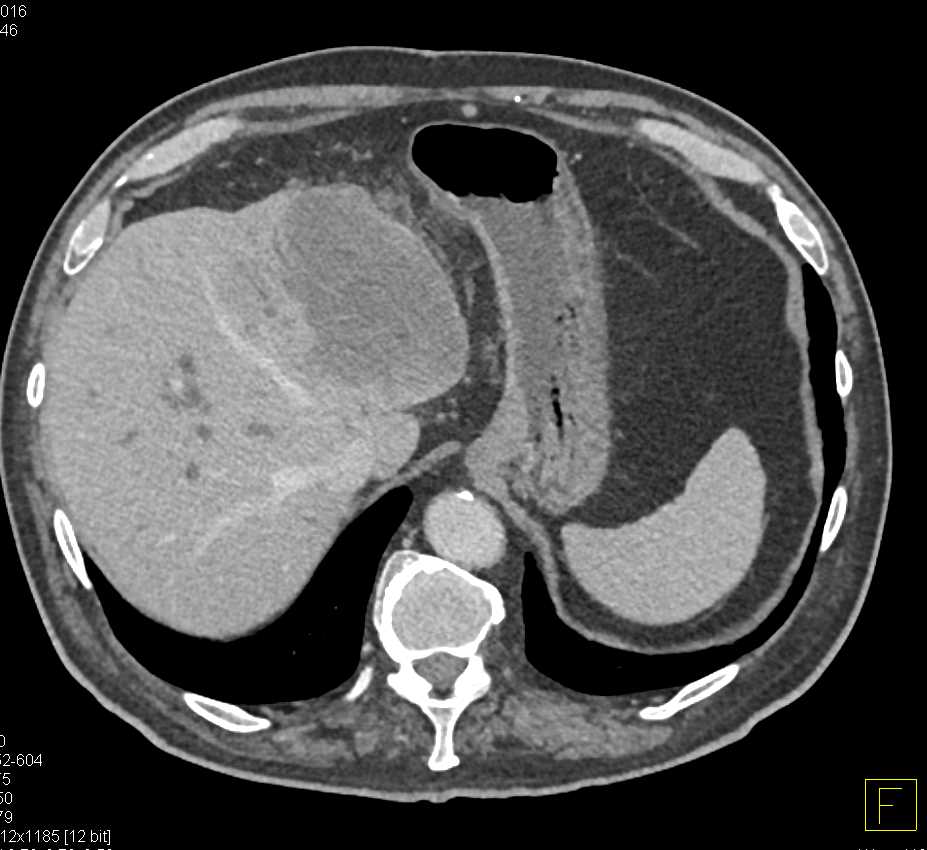 Cholangiocarcinoma - CTisus CT Scan