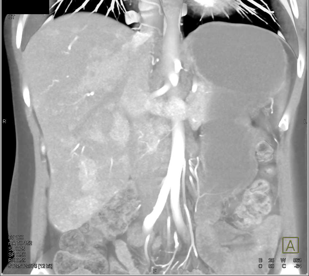 Cholangiocarcinoma with Adenopathy - CTisus CT Scan