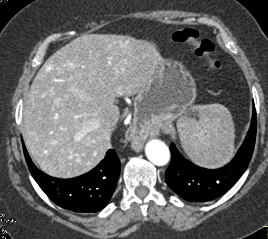 Multiple Arteriovenous (AV) Shunts in the Liver in a Patient with Hereditary Hemorrhagic Telangiectasia (HHT) Disease - CTisus CT Scan