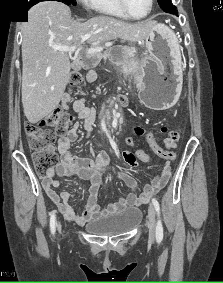 Hepatic Adenoma - CTisus CT Scan