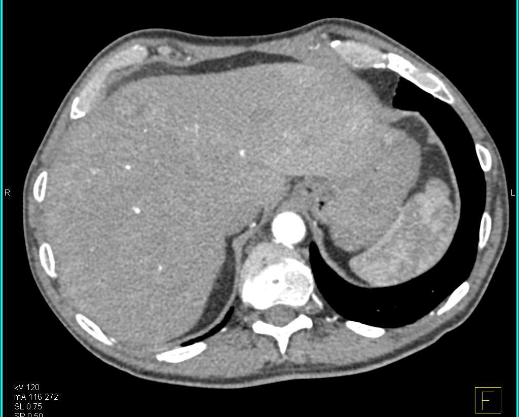 Liver Metastases from a Small Bowel Cancer - CTisus CT Scan