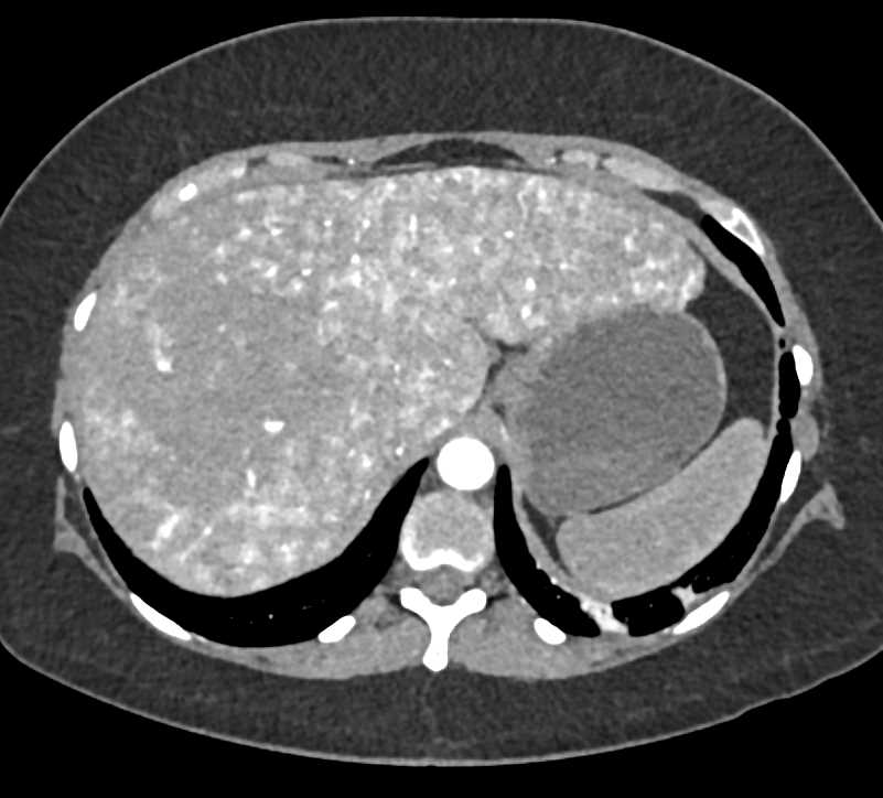 Metastatic Neuroendocrine Tumor to the Liver - CTisus CT Scan