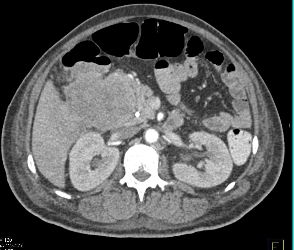 Cholangiocarcinoma - CTisus CT Scan