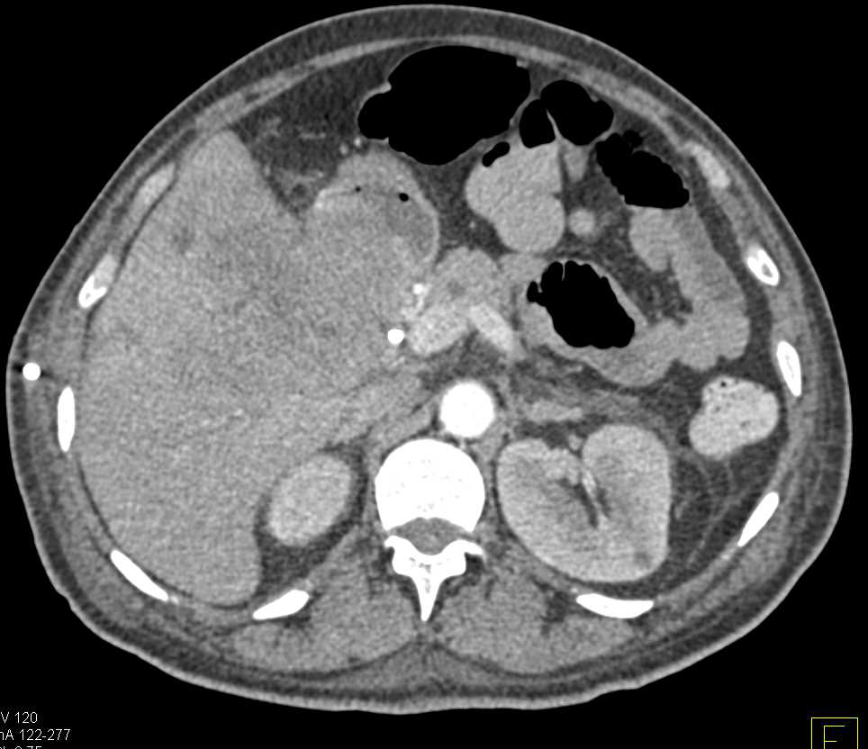 Invasive Cholangiocarcinoma - CTisus CT Scan