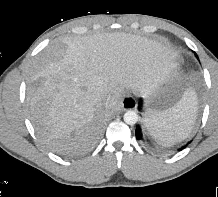 Hepatic Adenoma That Bleed - CTisus CT Scan