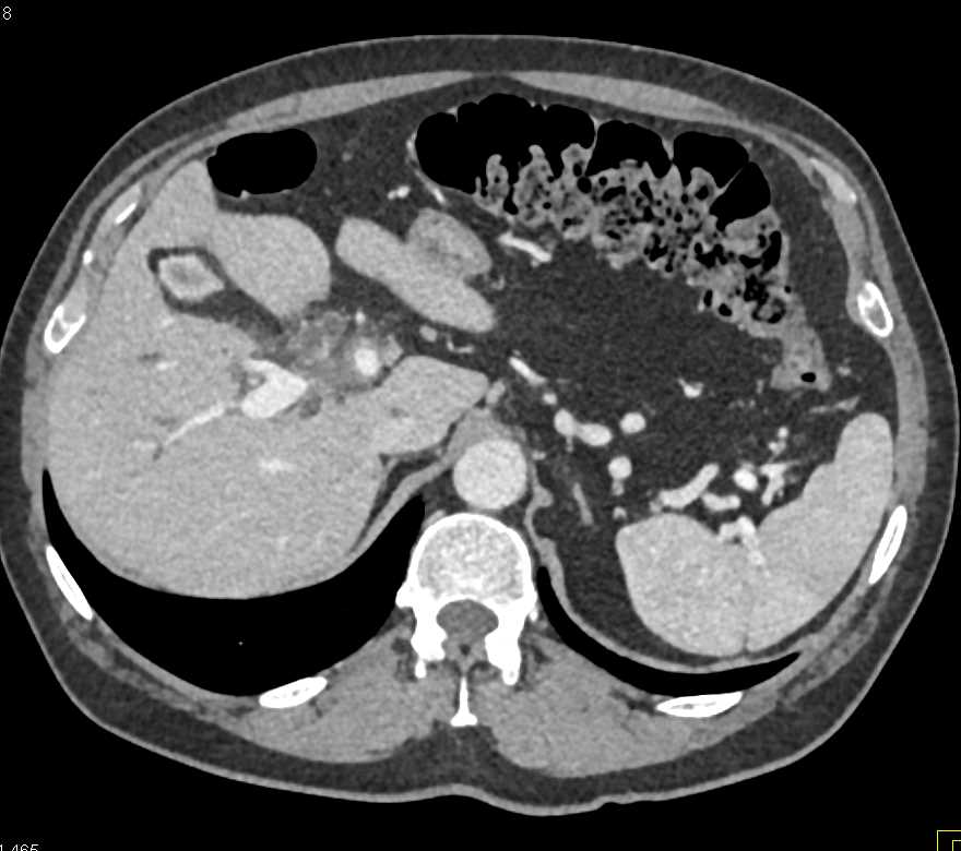 Cholangiocarcinoma Encases the Portal Vein - CTisus CT Scan