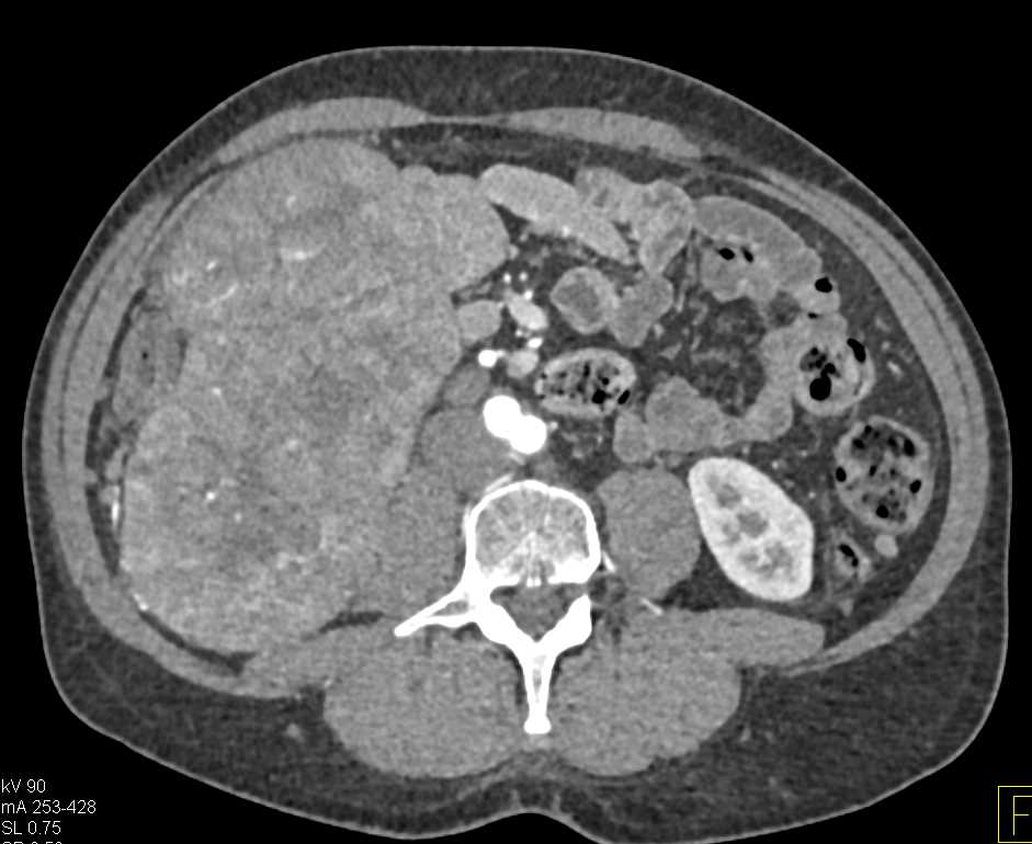 Hepatocellular Carcinoma (Hepatoma) with Extensive Neovascularity - CTisus CT Scan