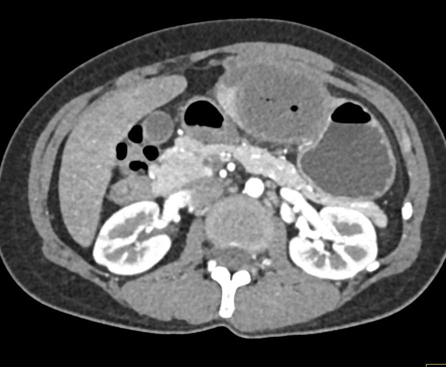 Abscess in the Left Lobe of the Liver - CTisus CT Scan