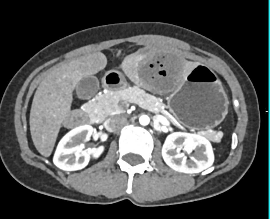 Abscess in the Left Lobe of the Liver - CTisus CT Scan