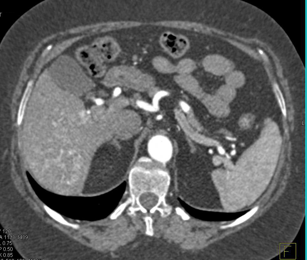 Infiltrating Hepatocellular Carcinoma (Hepatoma) - CTisus CT Scan