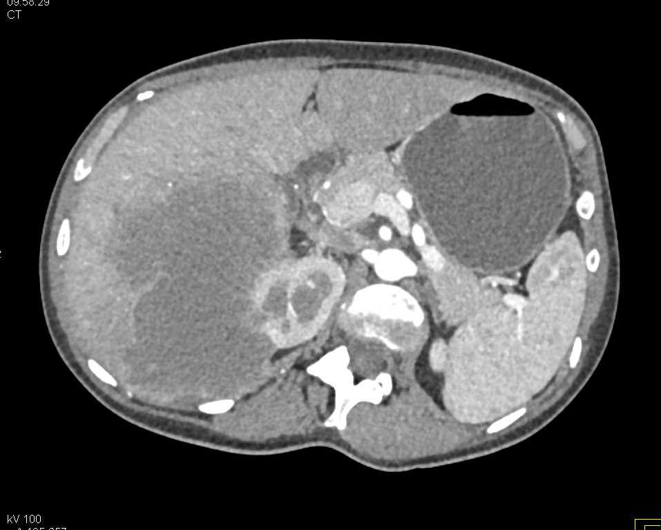 Hepatocellular Carcinoma (Hepatoma) Invades the Right Kidney - CTisus CT Scan